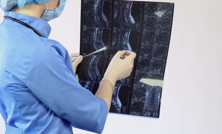 Η διάγνωση της «αυχενικής οστεοχόνδρωσης» γίνεται με βάση μια μελέτη μαγνητικής τομογραφίας