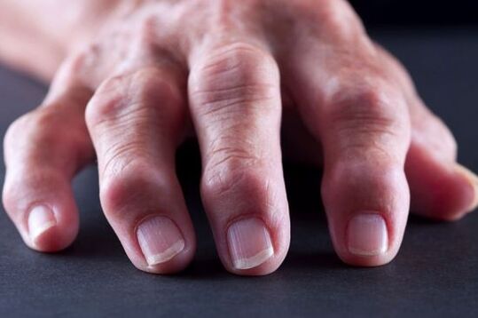 Αρθρικές παραμορφώσεις των δακτύλων λόγω αρθρίτιδας ή αρθρίτιδας